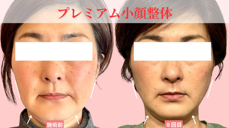 プレミアム小顔整体