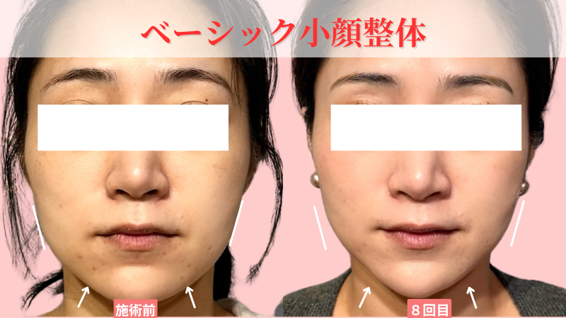 パーフェクト小顔整体